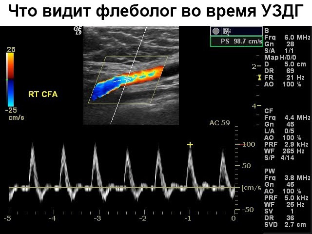 Доплер сосудов нижних конечностей – специфика и результативность