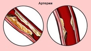 Самопомощь и неотложная помощь при стенокардии