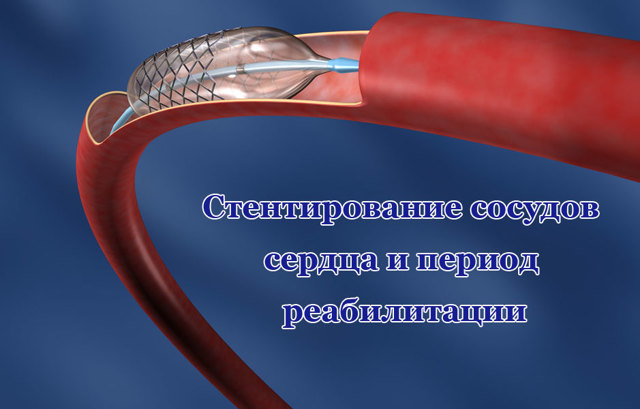 Как проводится стентирование сосудов сердца