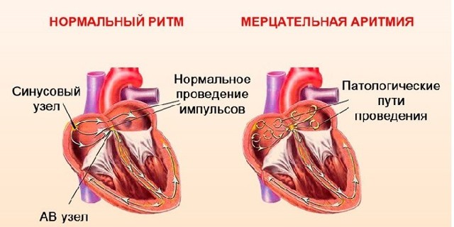 Тахикардия сердца: симптомы, диагностика и лечение - DELFI
