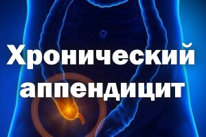 Хронический аппендицит у женщин и мужчин – симптомы, диагностика, лечение