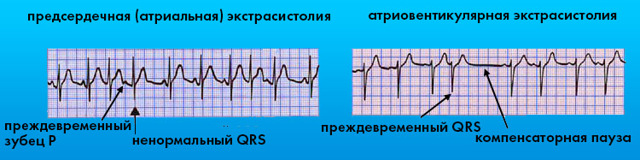 Картинки ЭКГ при нарушениях ритма