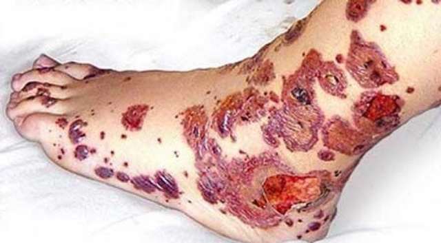 Идиопатическая тромбоцитопеническая пурпура.