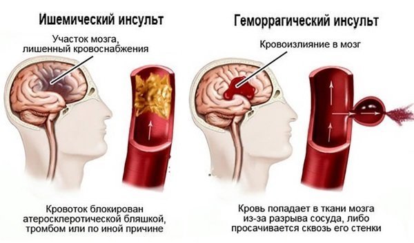 Инсульт левая или правая сторона, последствия, сколько живут