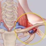Тромб в сонной артерии: лечение, симптомы и удаление