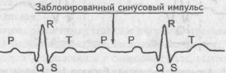 Атриовентрикулярная проводимость Википедия