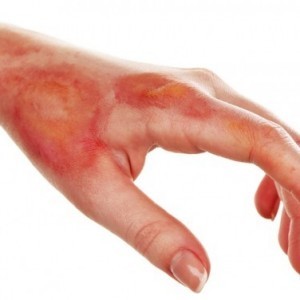 Ацербин спрей: инструкция по применению, показания, цена, отзывы врачей, аналоги спрея Ацербин