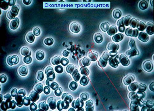 Агрегация тромбоцитов с АДФ, адреналином, ристомицином, коллагеном – норма. Что такое агрегация, гиперагрегация, гипоагрегация тромбоцитов?