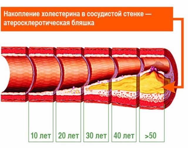 Как почистить сосуды: самые эффективные методы.