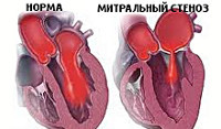 Митральный стеноз - симптомы, степени, лечение
