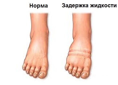 Отеки перед месячными (лица, ног, груди, живота, рук, глаз, тела): почему возникают, как снять и избавиться навсегда?