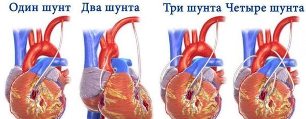 Современные способы хирургического лечения заболеваний сердца