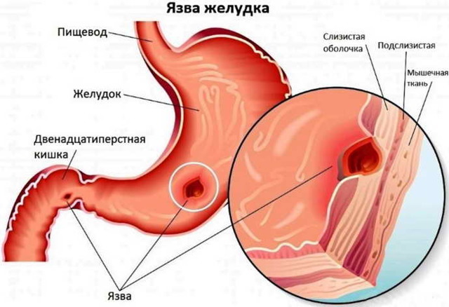 Белый налет на языке у взрослых: причины. Почему на языке белый налет, что это значит и как лечить