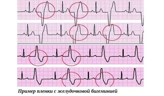 Экстрасистолы по типу бигеминии