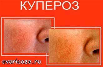 Капиллярная сетка – что это такое? Сосудистые звездочки на руках (купероз)
