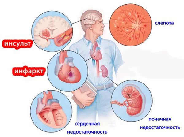 Признаки гипертонии - основные симптомы повышенного артериального давления