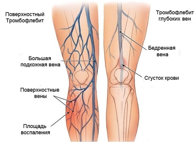 Ангиография сосудов нижних конечностей (КТ, МР, МСКТ): как проводится и что показывает
