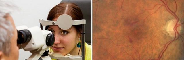 Ишемические заболевания сетчатки глаза и зрительного нерва