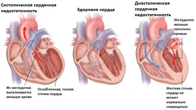 Отеки при сердечной недостаточности - патогенез, симптомы и лечение