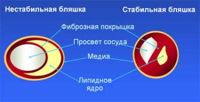 Атеросклеротические бляшки в сосудах: причины и симптомы
