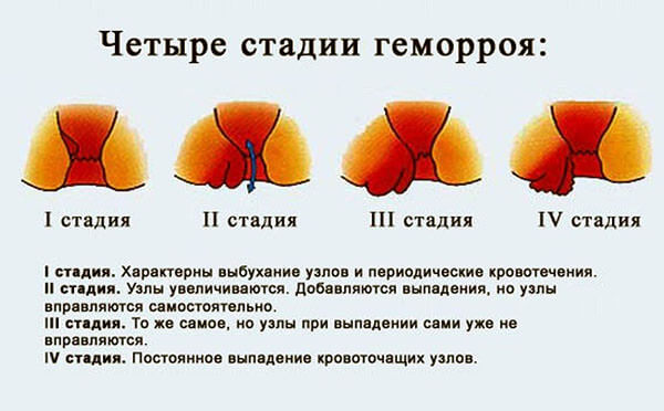 Внутренний геморрой лечение в домашних условиях