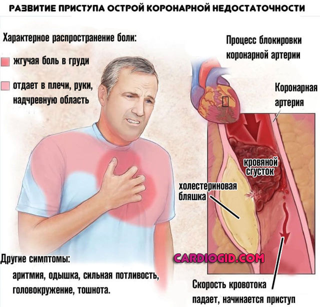 Стенокардия - что это такое, что делать при приступе
