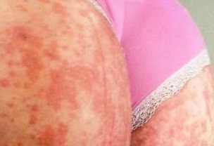 Флеминга мазь цена, Флеминга мазь купить, инструкция по применению, аналоги в Лаборатории Красоты и Здоровья