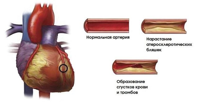 В сосудах бляшки: диагностика и терапия
