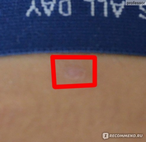 Как остановить кровь после пиявок и что означают сгустки крови после пиявок