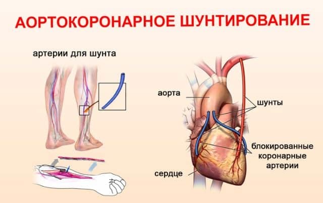 Операция после инфаркта миокарда