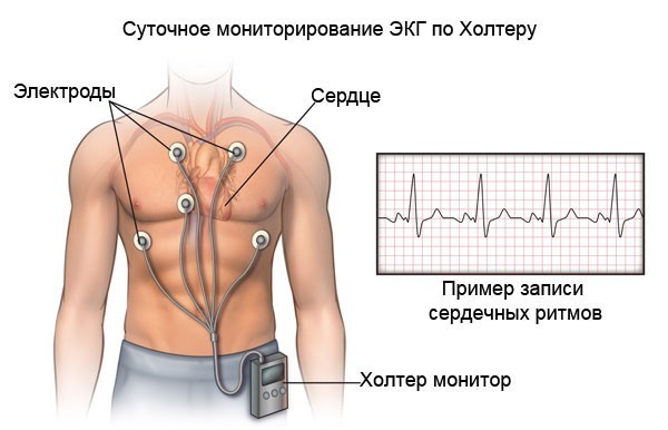 Cуточный мониторинг ЭКГ по методу Холтера - Лечим сердце