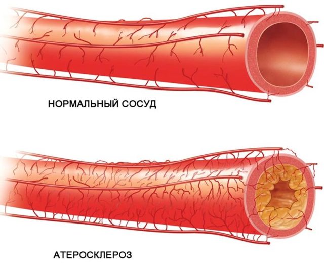 Бедренная артерия - анатомия - медицинская энциклопедия