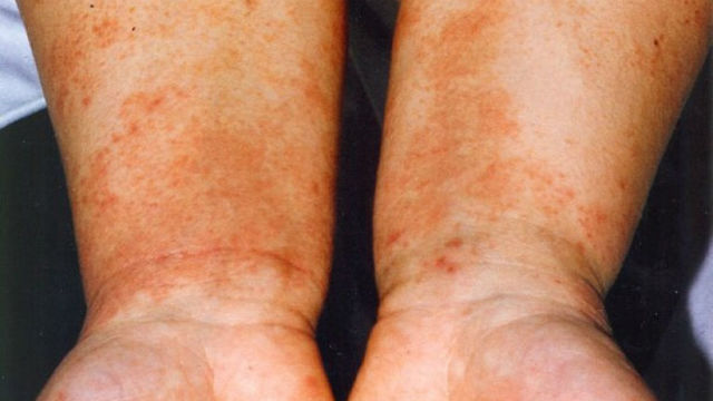 Нейродермит у взрослых и детей: симптомы (фото), лечение