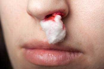 Почему идёт кровь из носа у взрослого человека. Причины и лечение народными средствами