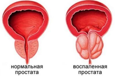 Жжение при мочеиспускании у мужчин - причины