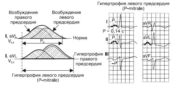 Гипертрофия левого желудочка сердца: признаки на ЭКГ и лечение