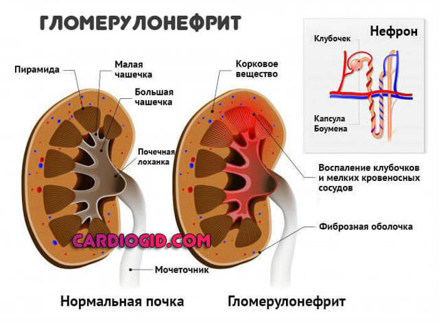 Высокое нижнее давление: причины и лечение