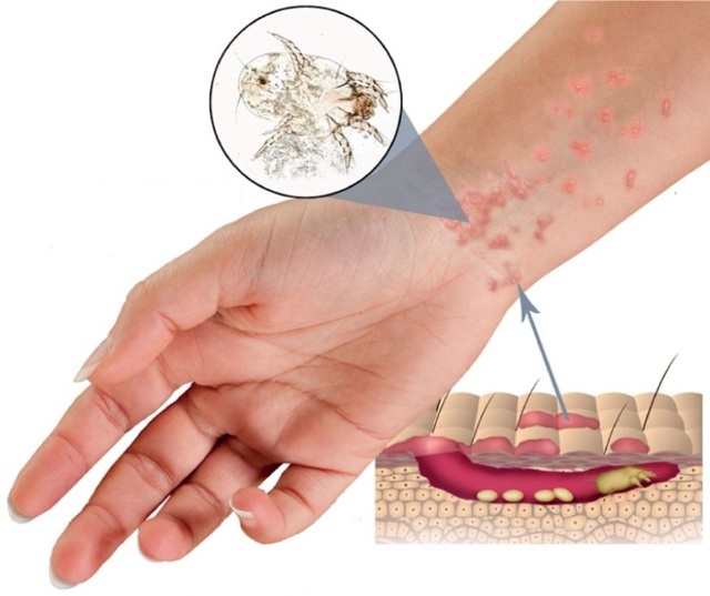 Красные пятна на теле у взрослого - появились красные пятнышки на лице