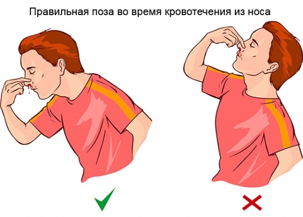 Как остановить кровотечение из носа в домашних условиях