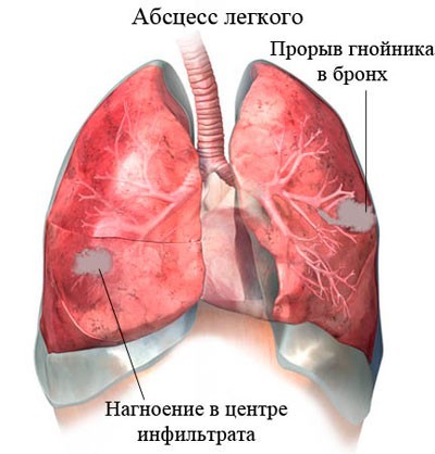 Гнойные заболевания легких. Острый абсцесс легкого