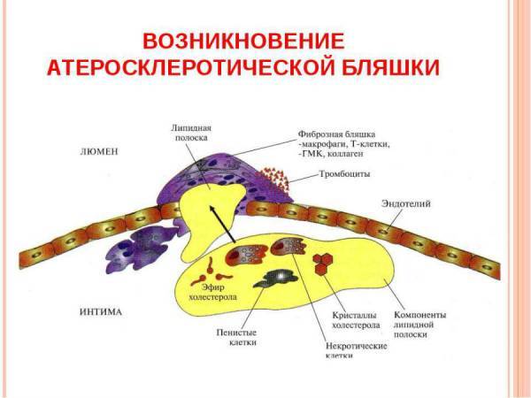Атеросклеротические бляшки в сосудах: причины и симптомы