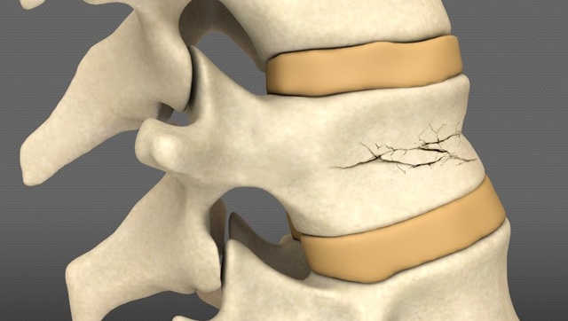 Как убрать горб на спине: эффективные способы лечения