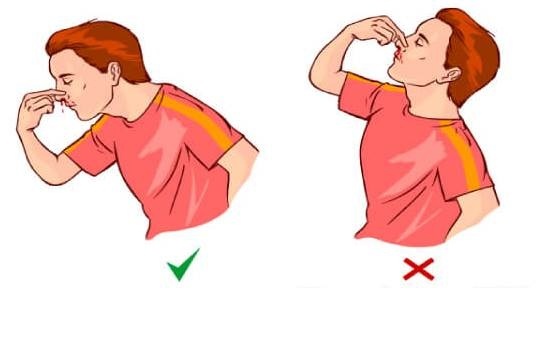 Первая помощь при кровотечении из носа: как правильно оказать медицинскую помощь (алгоритм) при сильном кровотечении, что нужно делать чтобы из носа пошла кровь без боли