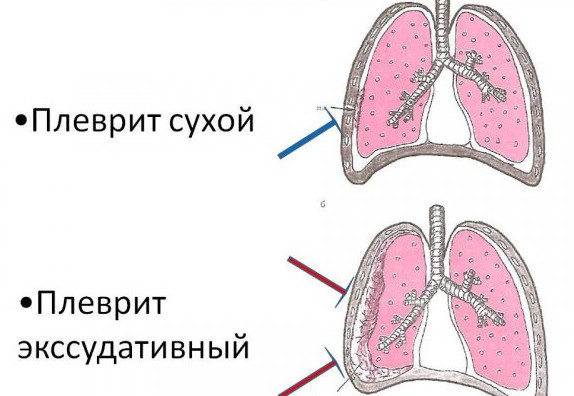 Что означает боль в грудине посередине