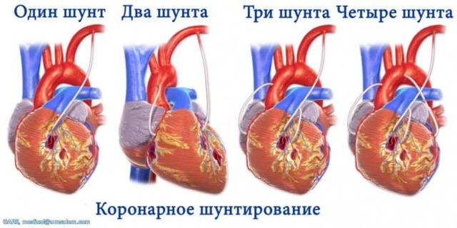 АКШ (аортокоронарное шунтирование): открытая операция на сердце при атеросклерозе