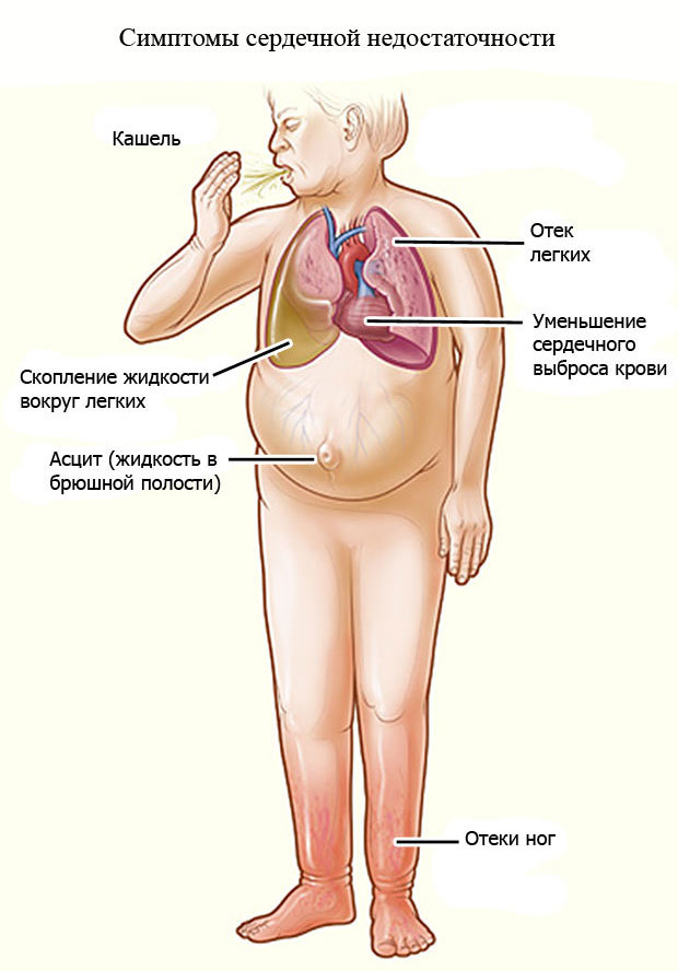 Приобретенный порок сердца