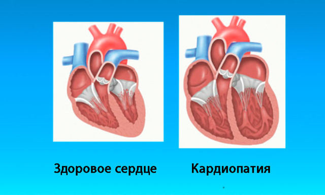 Кардиопатия сердца: симптомы, диагностика и лечение. Что такое кардиопатия у детей? Кардиопатия у детей и взрослых: причины, симптомы, лечение и возможные последствия.