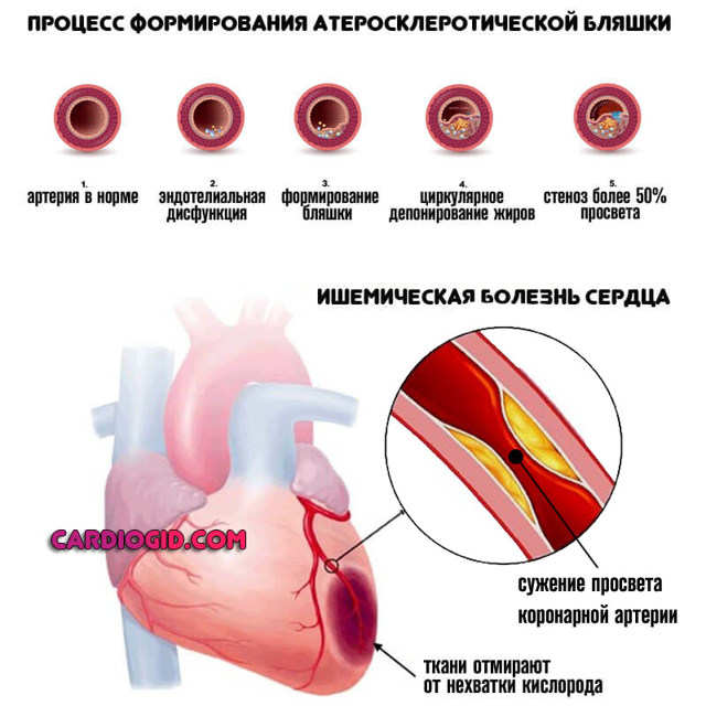 ПМК 1 степени - симптомы, лечение, диагностика