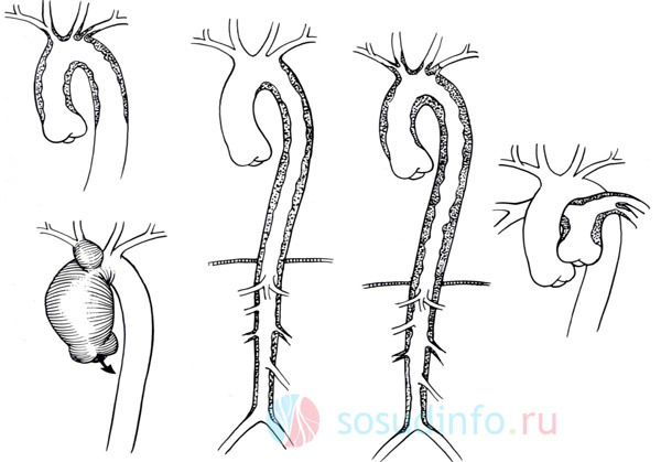 Артериит Такаясу — обследование, диагноз