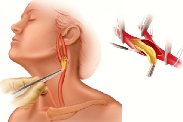 Тромб в сонной артерии: лечение, симптомы и удаление